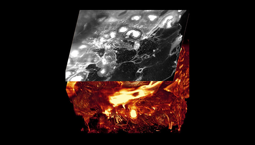 Ultramikroskopie bei Brustkrebs – Tumor in 3D